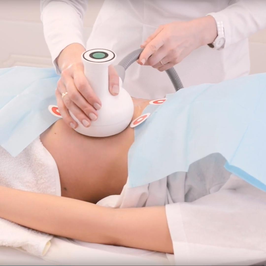 ULTRASHAPE POWER - дерматологичен център АТА-Дерма, гр. Пловдив ULTRASHAPE POWER - ултразвуков апарат за разграждане на мастните клетки под кожата (снимка)